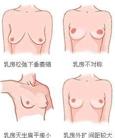 乳房圖