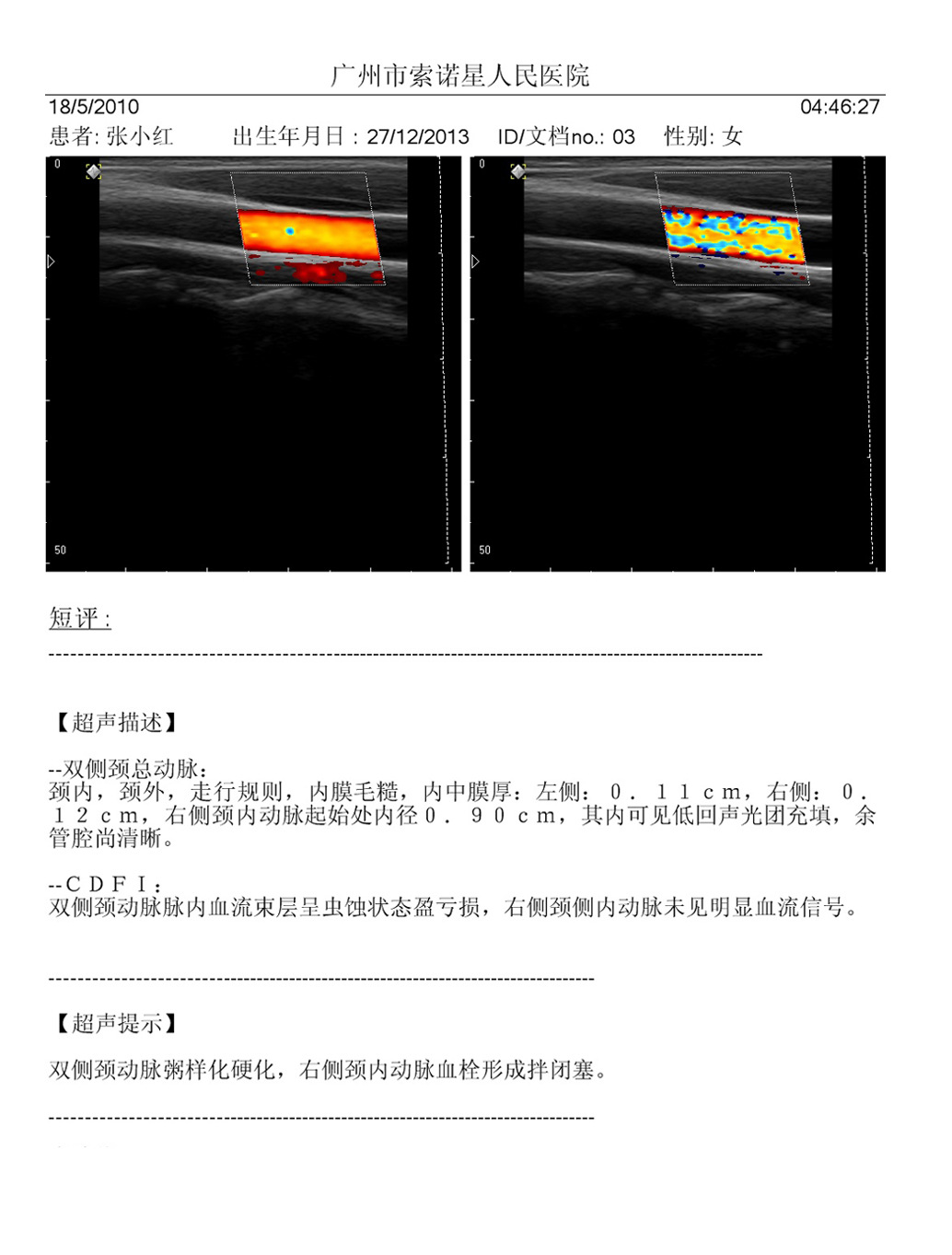 会销老年人心脑血管颈动脉多普勒斑块彩超机 超声波健康检测仪