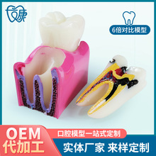 6倍對比模型牙科教學器材6倍齲齒對比模型口腔模型教學牙齒模型