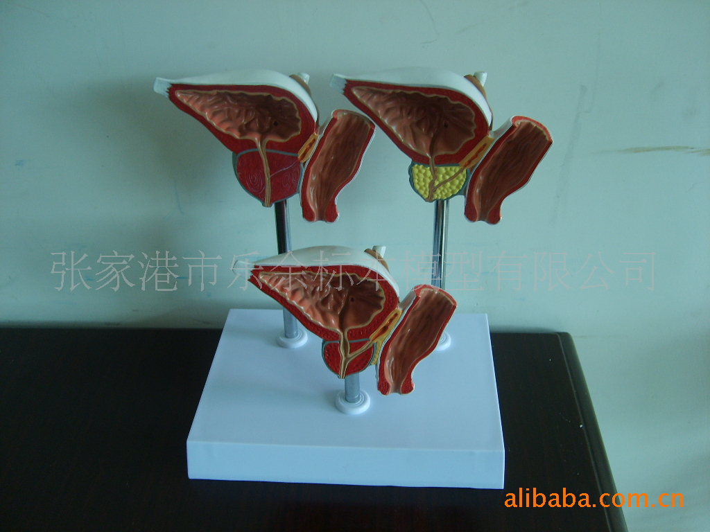 前列腺正常,增生和癌(3个一套)-病理.教学.医学.解剖模型
