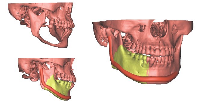 下颌骨客制化设计与制造,下颌骨重建