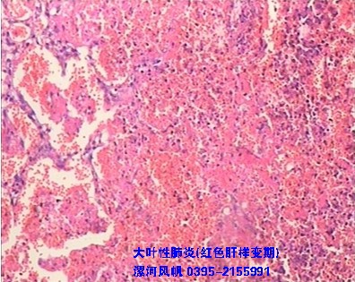 漯河风帆医学 大叶性肺炎(红色肝样变期) 组织切片