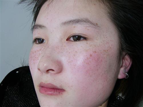 清凉夏季护肤# 课题二 ——女性斑点形成的原因